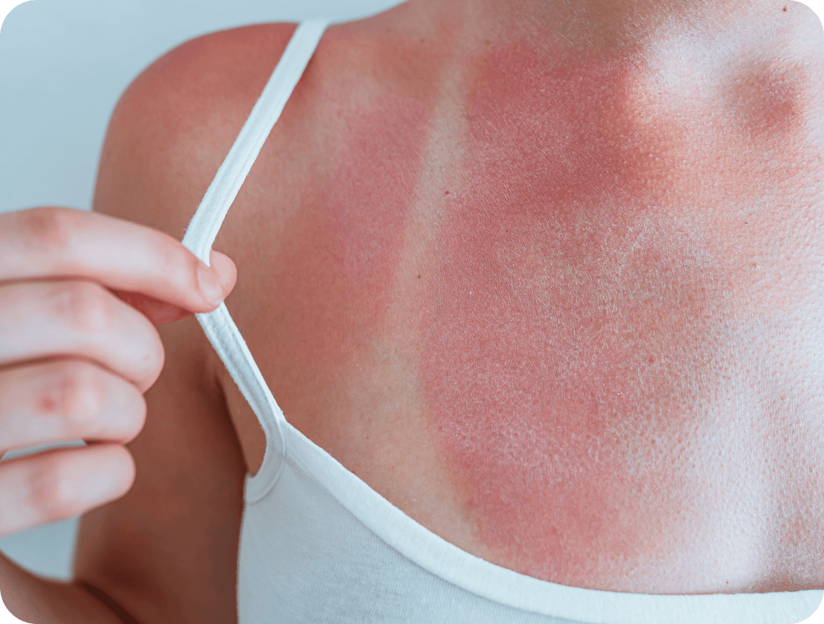 Astaxanthin, Sunburn, Image of a Woman